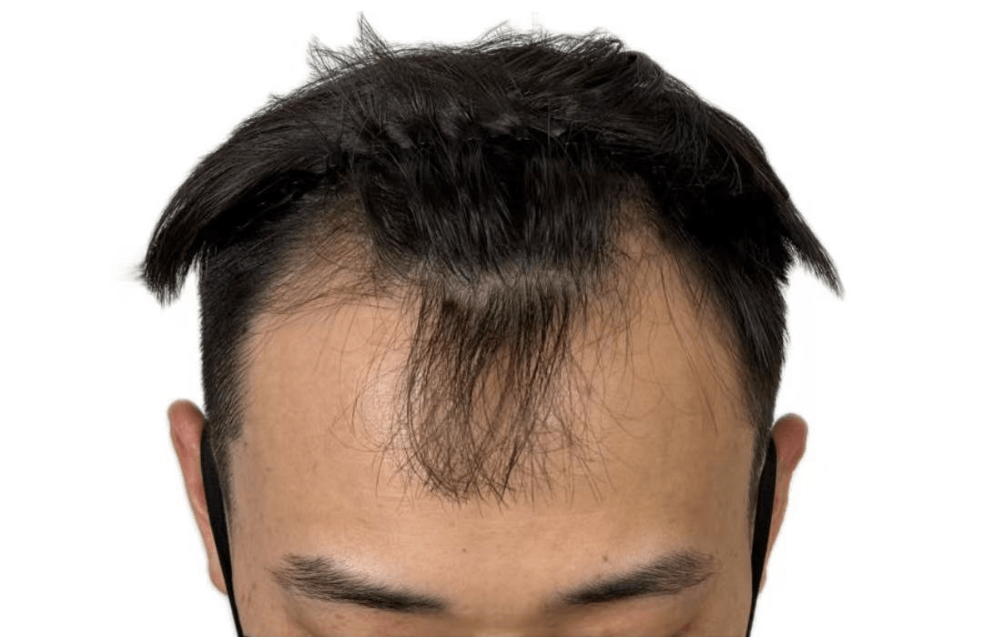 M型发际线术前图