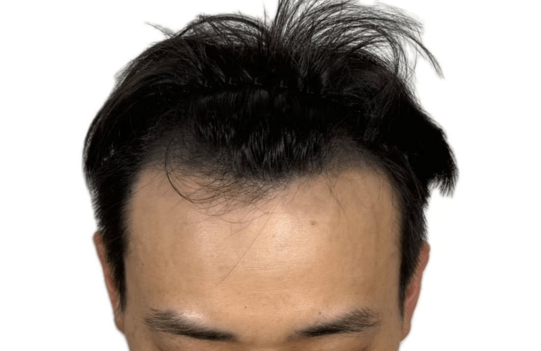 M型发际线术后图