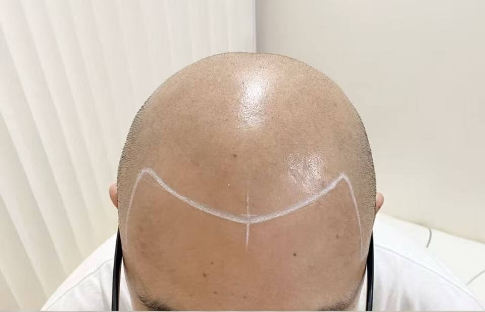 全秃覆盖术前图
